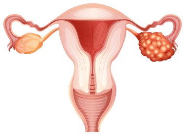 Ovarian cancer in woman clipart