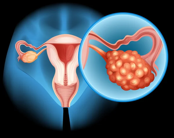 Diagrama del cáncer de ovario en detalle — Vector de stock