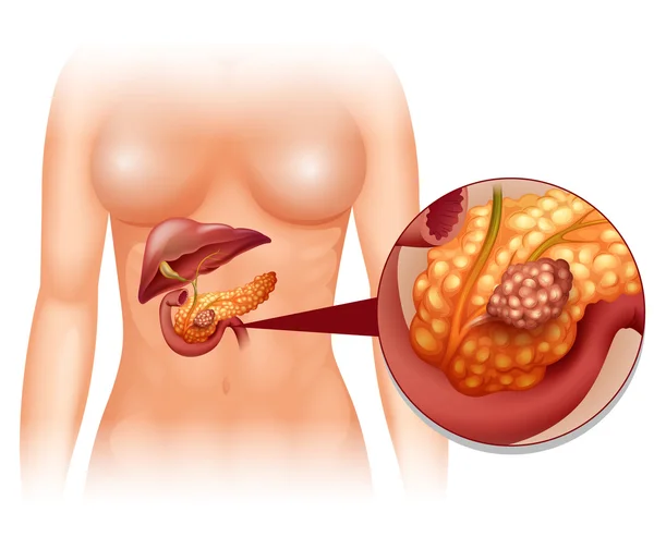 Cancro do pâncreas na mulher — Vetor de Stock