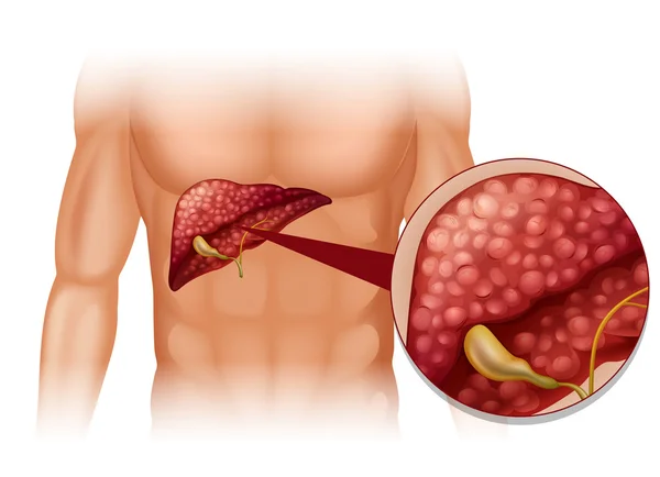 Diagrama de la esclerosis en humanos — Archivo Imágenes Vectoriales