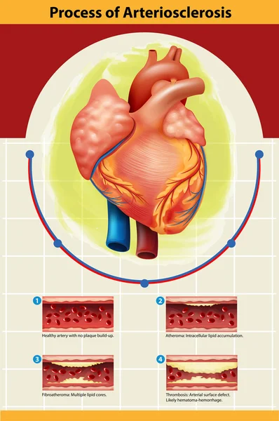 动脉粥样硬化过程的海报 — 图库矢量图片