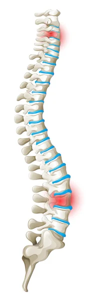 Vissza a gerinc fájdalom diagram — Stock Vector