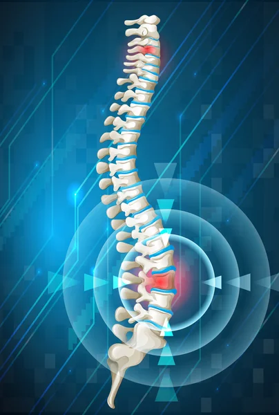 背中の痛みを示す人間の背骨 — ストックベクタ