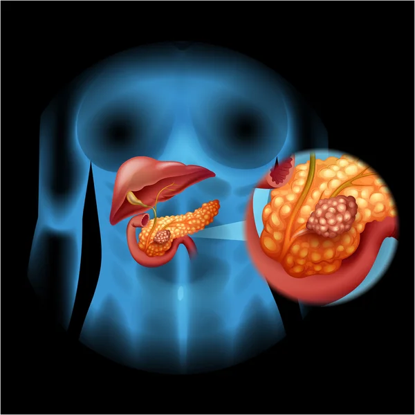 Діаграма раку підшлункової залози в деталях — стоковий вектор