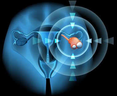 Ovarian diagram with focus clipart