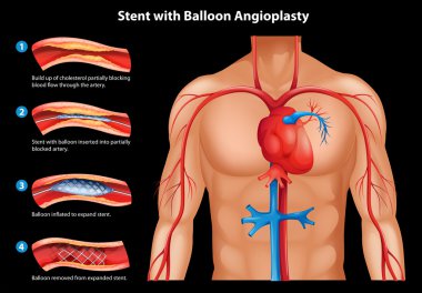 Balon anjiyoplasti ile stent