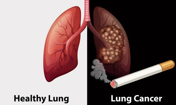 Polmone sano contro il diagramma del cancro al polmone — Vettoriale Stock