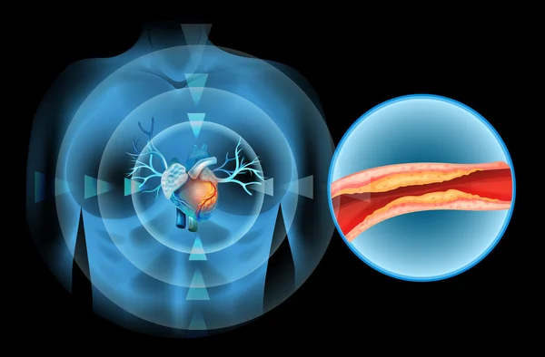 Cholesteral klokte in het menselijke hart — Stockvector