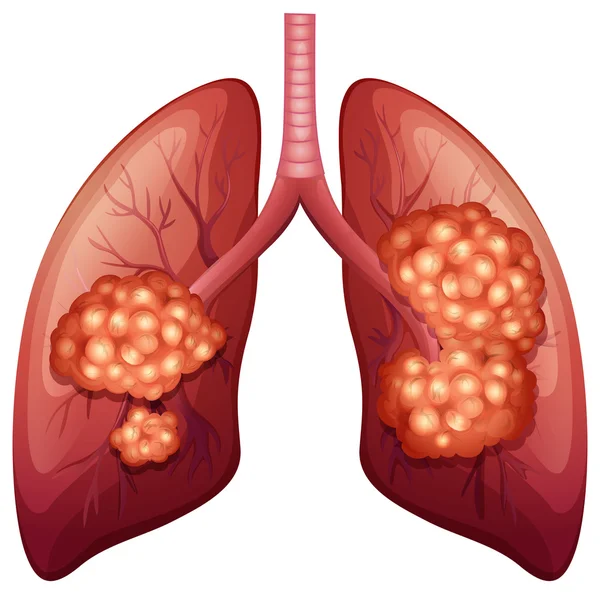 Proceso de cáncer de pulmón en detalle — Vector de stock
