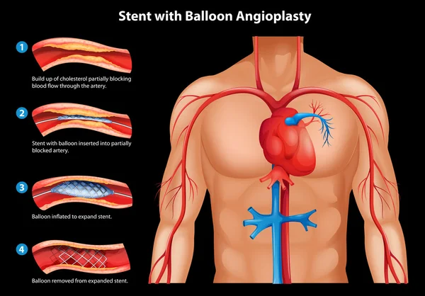 A ballon angioplasztika stent — Stock Vector