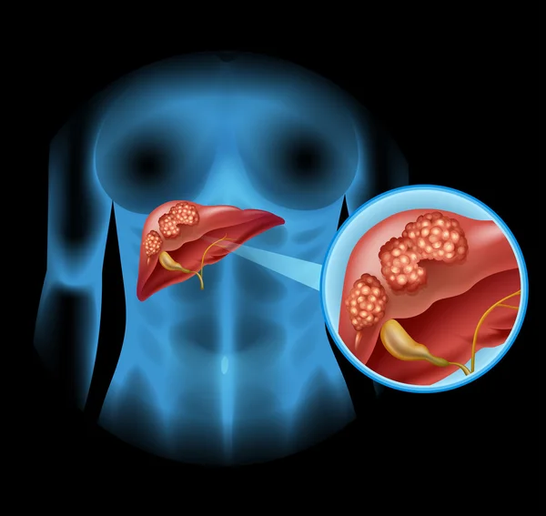Diagramme du cancer du foie en détail — Image vectorielle