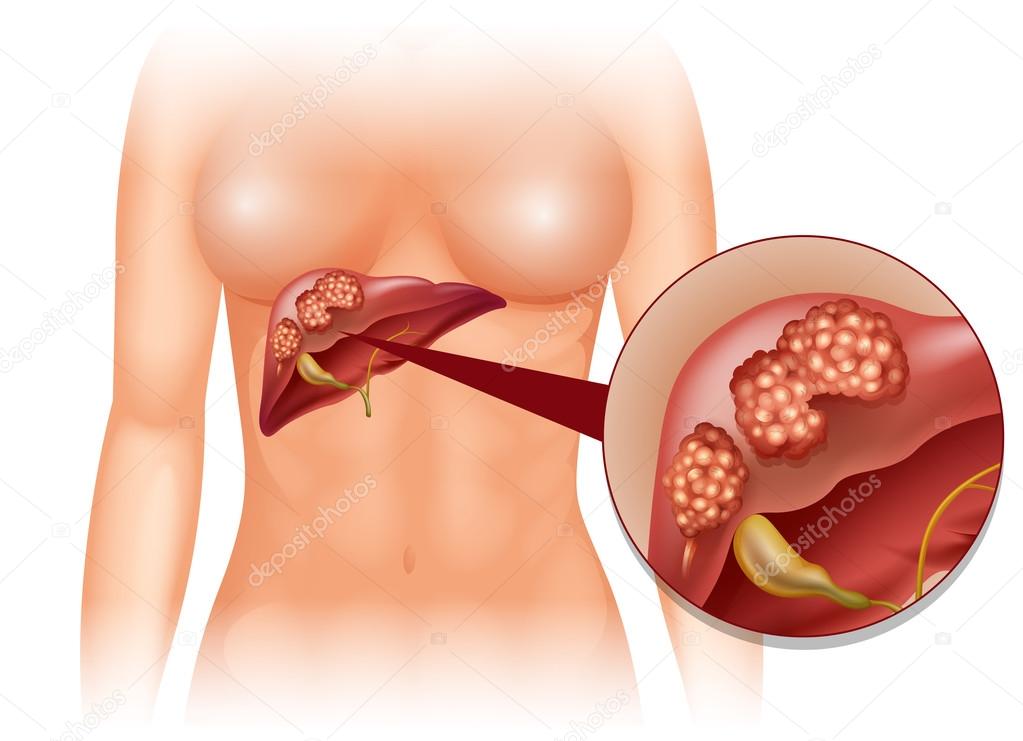 Liver cancer diagram in detail