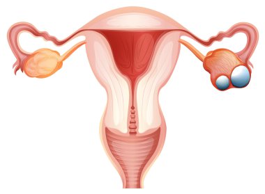 Ovarian cancer diagram in woman clipart