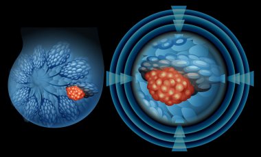 Position of breast cancer	
