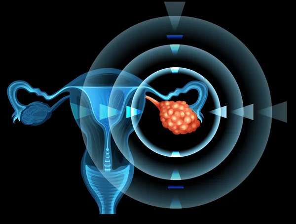 Cáncer en ovario de mujer — Archivo Imágenes Vectoriales