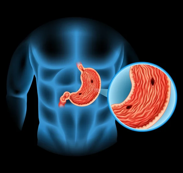 Διάγραμμα έλκος στομάχου σε ανθρώπινο — Διανυσματικό Αρχείο