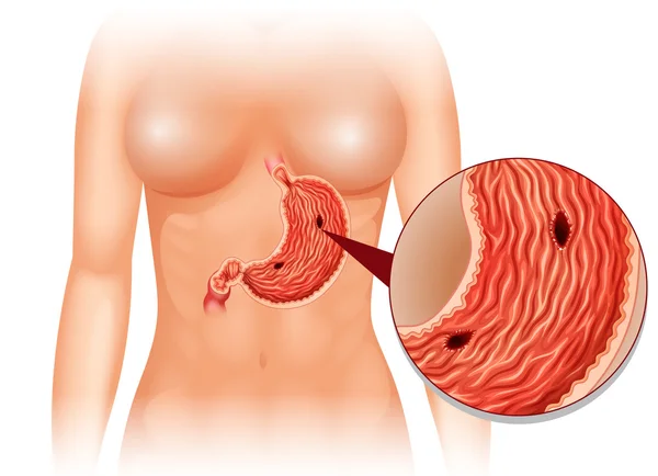 Diagrama de úlcera estomacal en mujer — Vector de stock