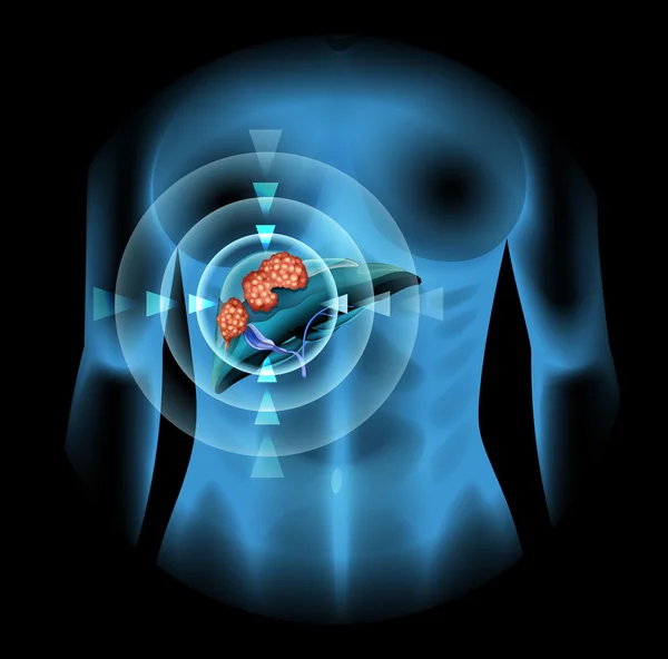 Lever kanker diagram in mens — Stockvector