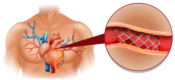 Heart disease diagram in human — Stock Vector