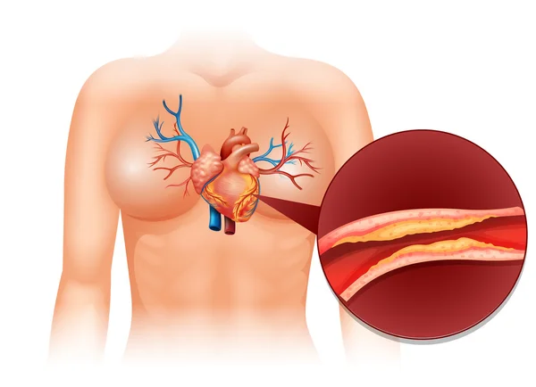 Corazón Colesteral en humanos — Archivo Imágenes Vectoriales