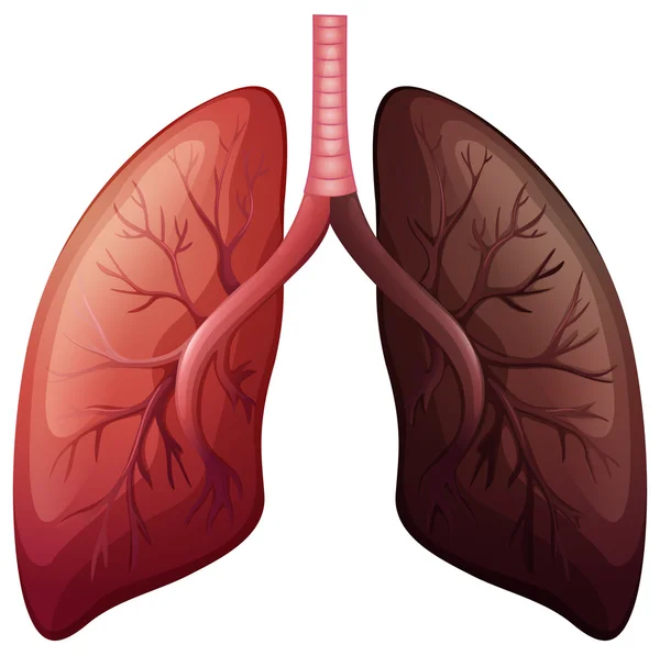 Lung cancer diagram in large scale — Stock Vector