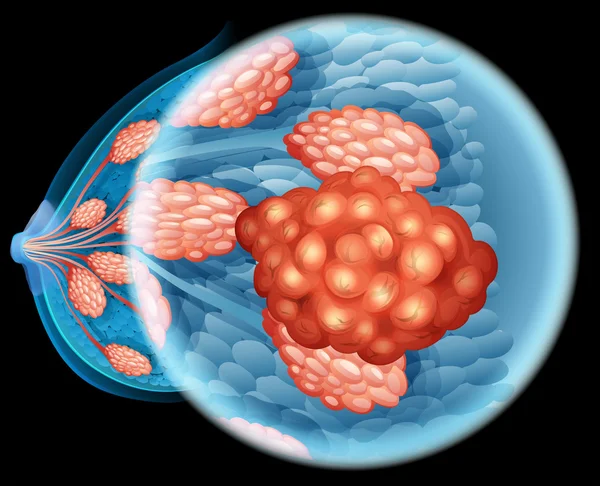 Рак молочной железы — стоковый вектор