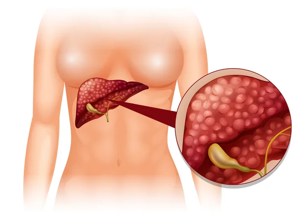 Cancro della sclerosi nel corpo umano — Vettoriale Stock