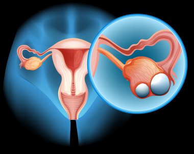 Ovarian cancer in human clipart