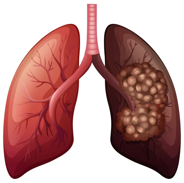 Cancro normale ai polmoni e ai polmoni — Vettoriale Stock