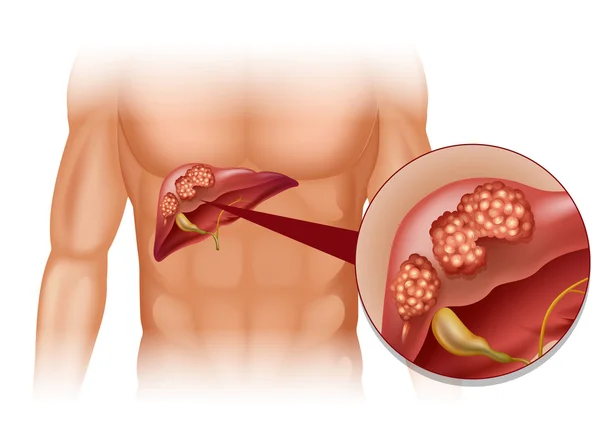 Cancro al fegato nell'uomo — Vettoriale Stock