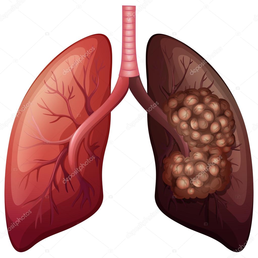 Normal lung and lung cancer