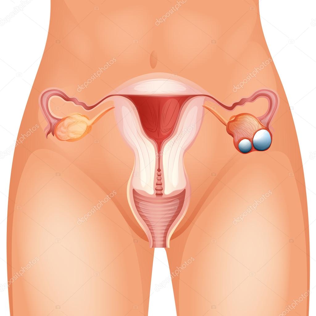Ovarian cancer in woman