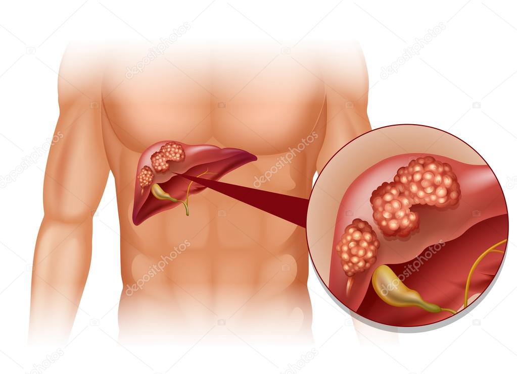 Liver cancer in human