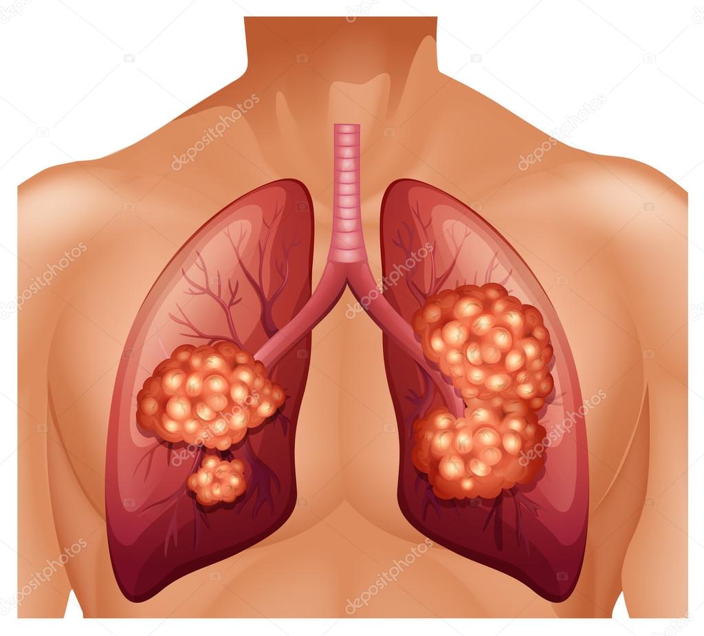 Lung cancer in human