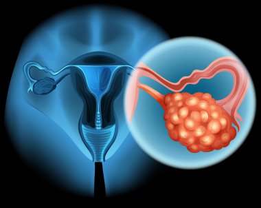 Ovarian cancer in human clipart