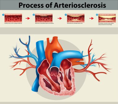 Poster of process of artriosclerosis clipart