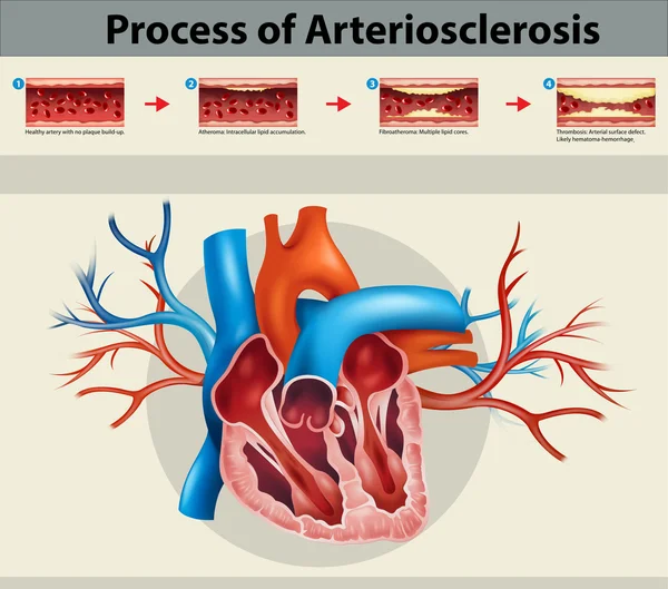 Affiche du processus d'artriosclérose — Image vectorielle