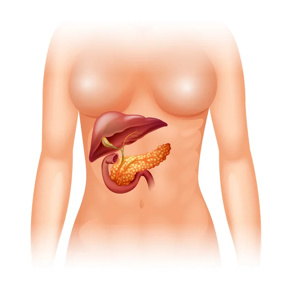 Cancro al pancreas nell'uomo — Vettoriale Stock