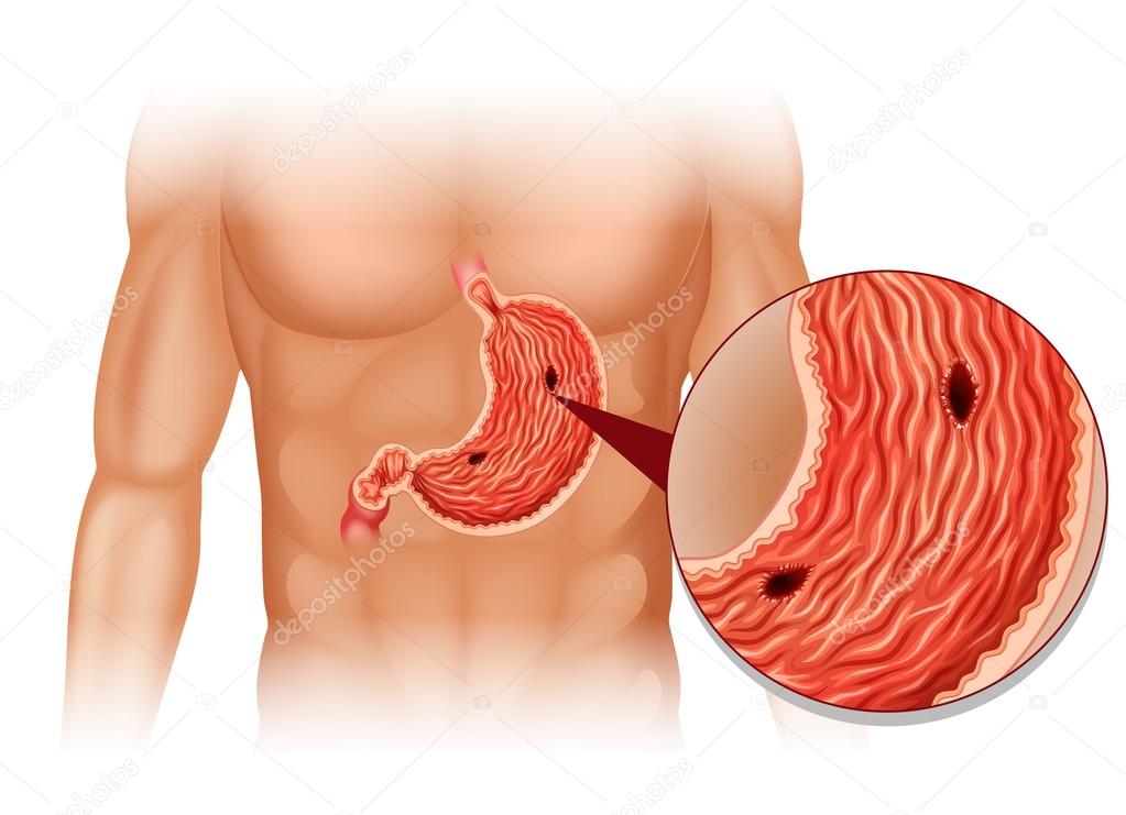 Stomach Ulcer in human body