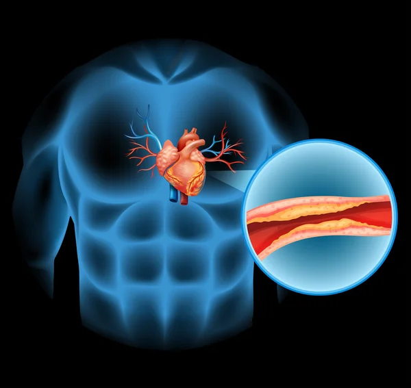 Colesterale del cuore nel corpo umano — Vettoriale Stock