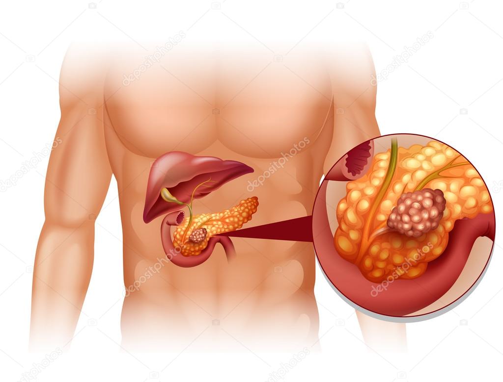 Pancreas cancer in human body
