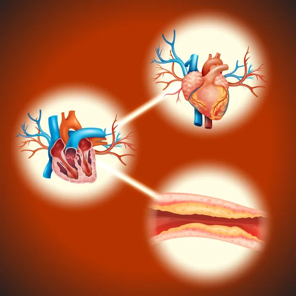 Cholesteral dans le cœur humain — Image vectorielle