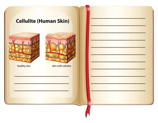 Celulitis bajo la piel humana — Vector de stock