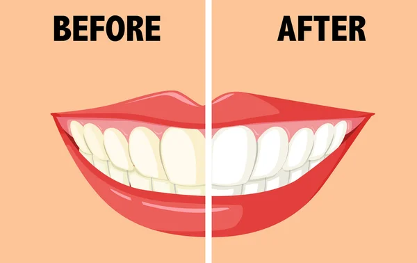 Prima e dopo essersi lavati i denti — Vettoriale Stock