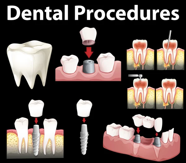 Dentale procedimentos de fazer dente falso — Vetor de Stock