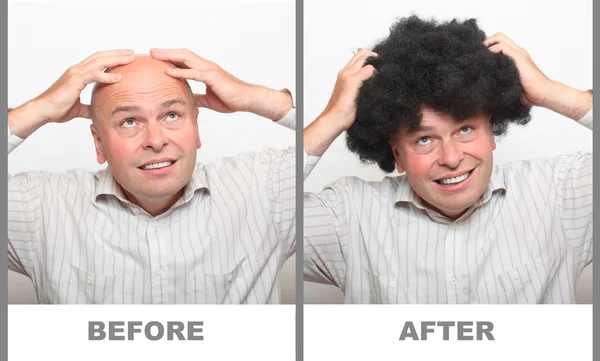 Hairless man and man with beautiful hair — Stock Photo, Image