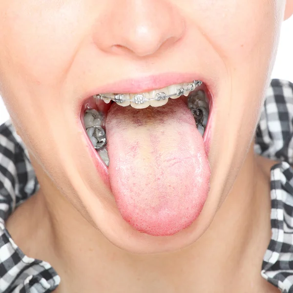 Молодая женщина в ортодонтических брекетах — стоковое фото