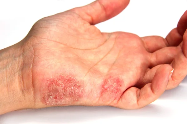 Skin Disease — Stock Photo, Image