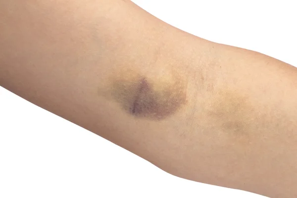 Bruise op de witte achtergrond — Stockfoto