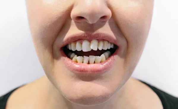 Женщина открыла рот с кривыми зубами — стоковое фото